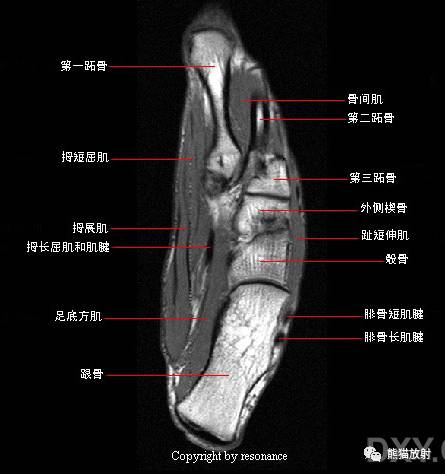踝关节系统解剖图+冠/矢/轴MRI 踝关节系统解剖图+冠/矢/轴MRI