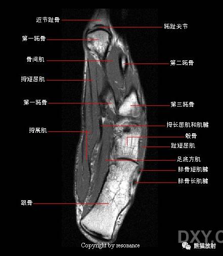 踝关节系统解剖图+冠/矢/轴MRI 踝关节系统解剖图+冠/矢/轴MRI