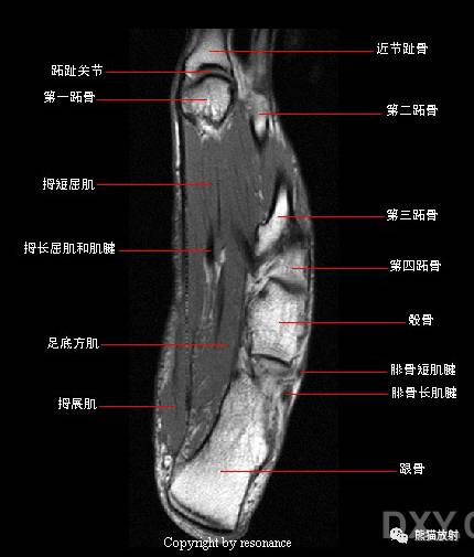 踝关节系统解剖图+冠/矢/轴MRI 踝关节系统解剖图+冠/矢/轴MRI