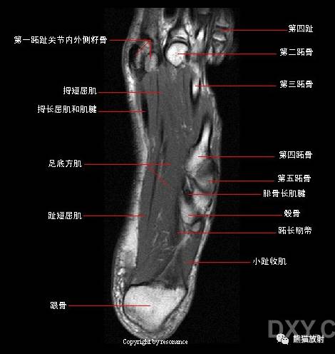 踝关节系统解剖图+冠/矢/轴MRI 踝关节系统解剖图+冠/矢/轴MRI