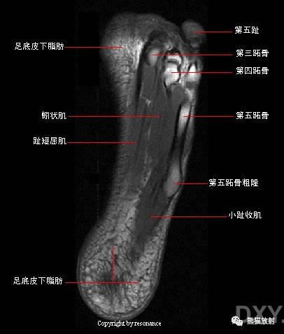踝关节系统解剖图+冠/矢/轴MRI 踝关节系统解剖图+冠/矢/轴MRI