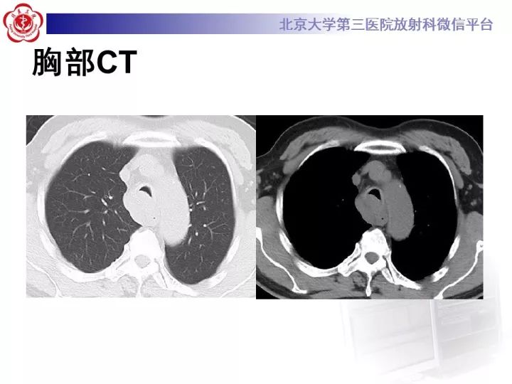【病例】气管肿瘤1例CT影像诊断