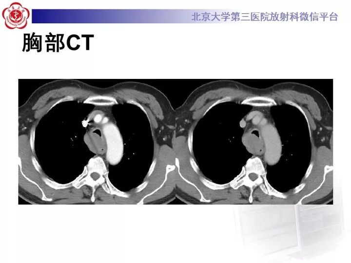 【病例】气管肿瘤1例CT影像诊断
