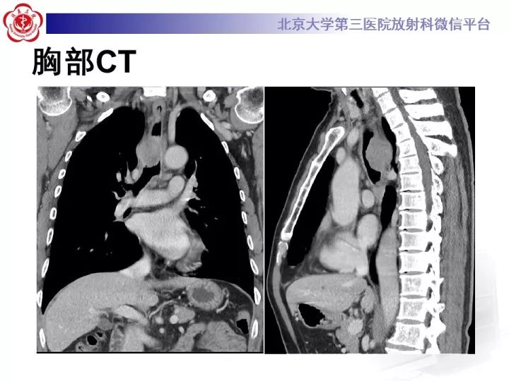 【病例】气管肿瘤1例CT影像诊断