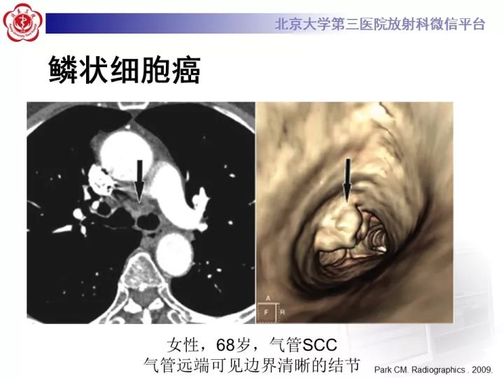 【病例】气管肿瘤1例CT影像诊断