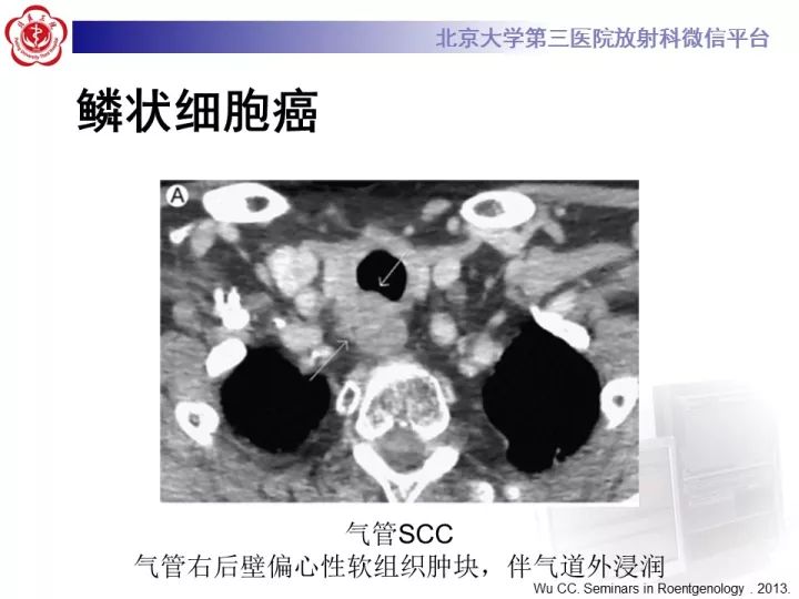 【病例】气管肿瘤1例CT影像诊断