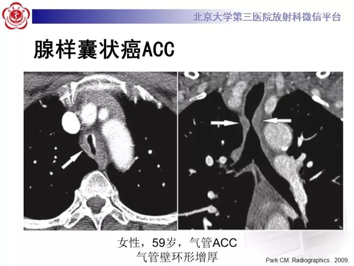 【病例】气管肿瘤1例CT影像诊断