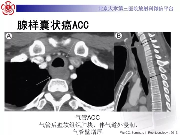 【病例】气管肿瘤1例CT影像诊断