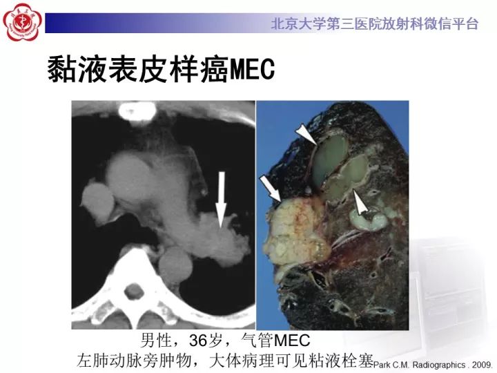 【病例】气管肿瘤1例CT影像诊断