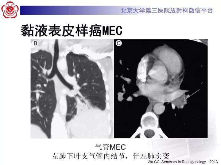 【病例】气管肿瘤1例CT影像诊断