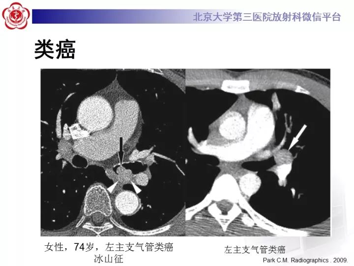 【病例】气管肿瘤1例CT影像诊断