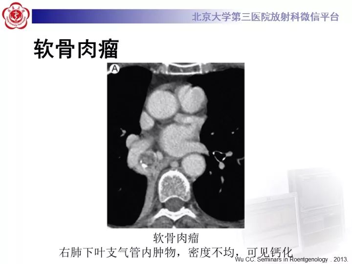 【病例】气管肿瘤1例CT影像诊断