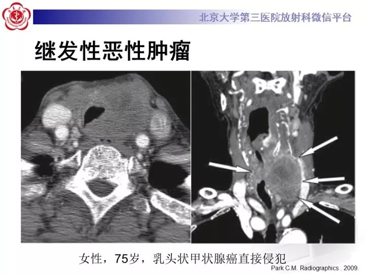 【病例】气管肿瘤1例CT影像诊断