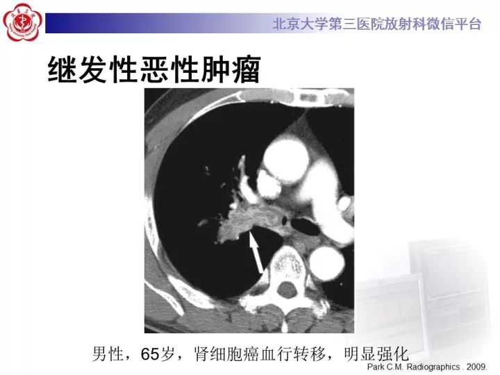 【病例】气管肿瘤1例CT影像诊断