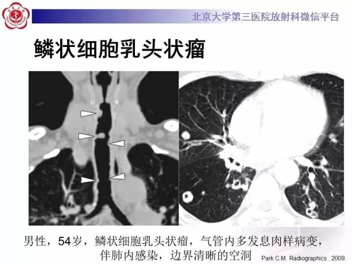【病例】气管肿瘤1例CT影像诊断