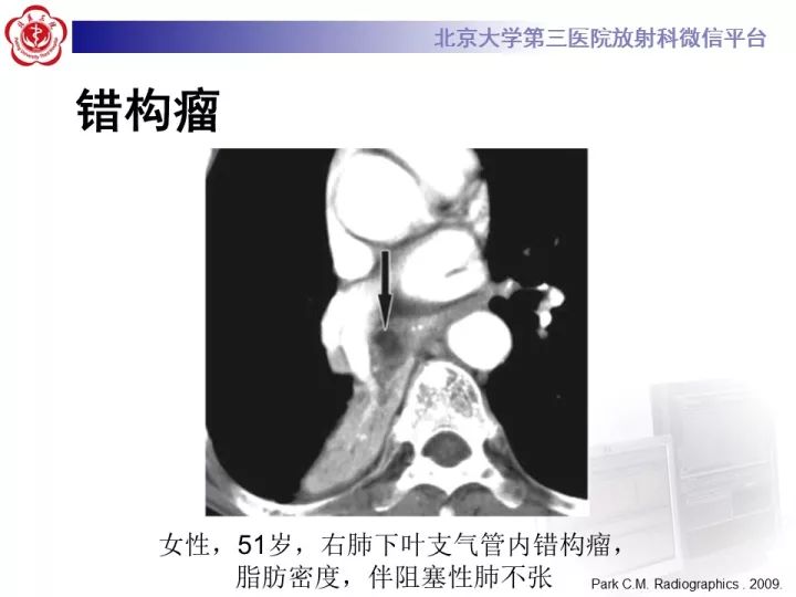 【病例】气管肿瘤1例CT影像诊断