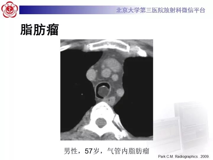 【病例】气管肿瘤1例CT影像诊断