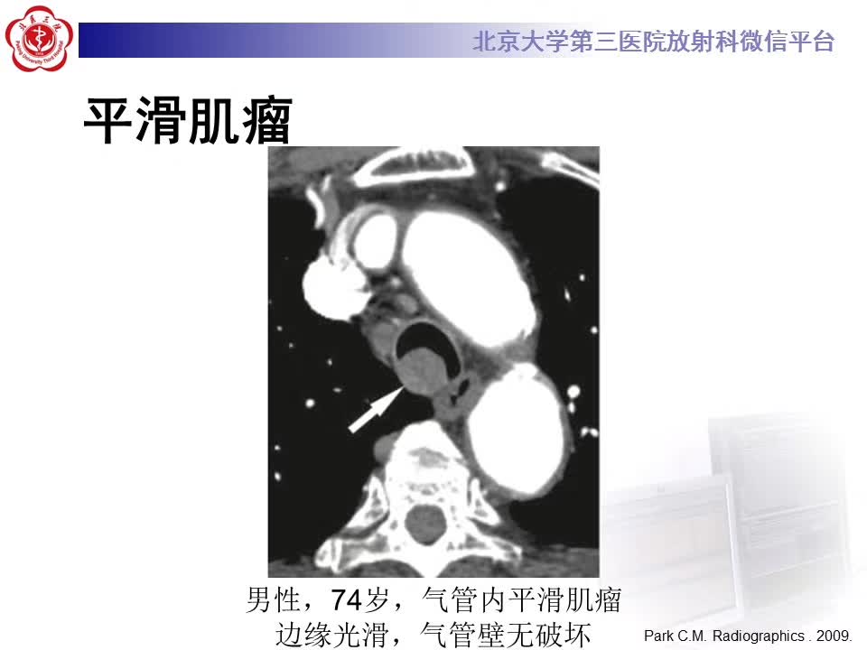 【病例】气管肿瘤1例CT影像诊断