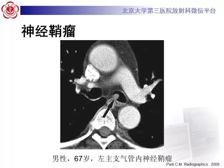 【病例】气管肿瘤1例CT影像诊断