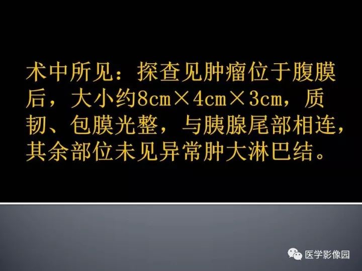 【病例】腹膜后孤立性纤维瘤1例CT影像表现