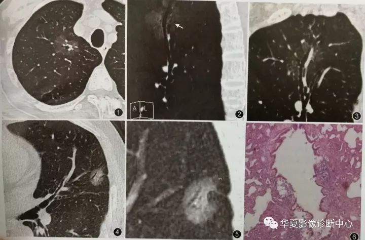 空气支气管征诊断纯磨玻璃结节型肺癌的意义