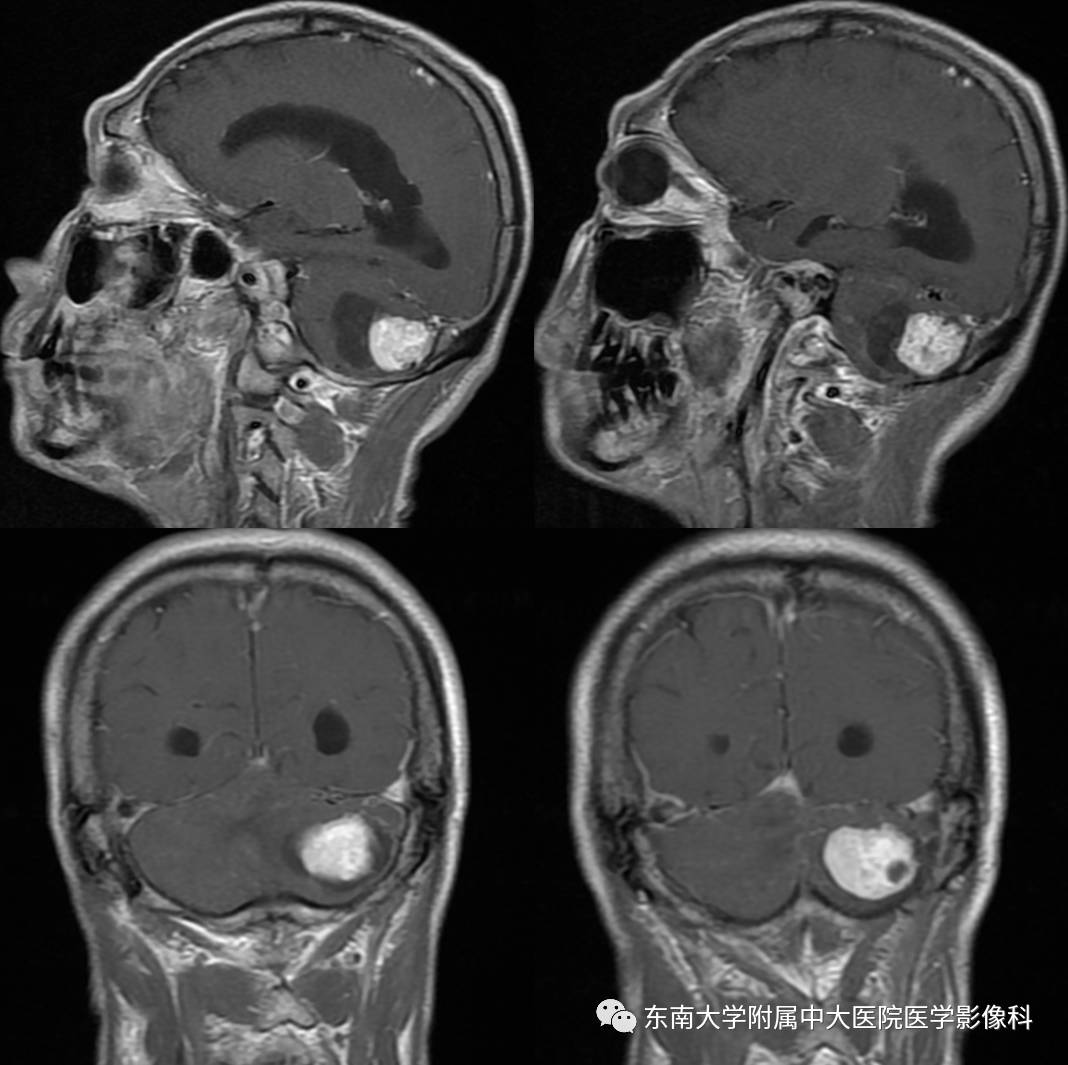 【病例】成人小脑肿瘤2例MR影像诊断