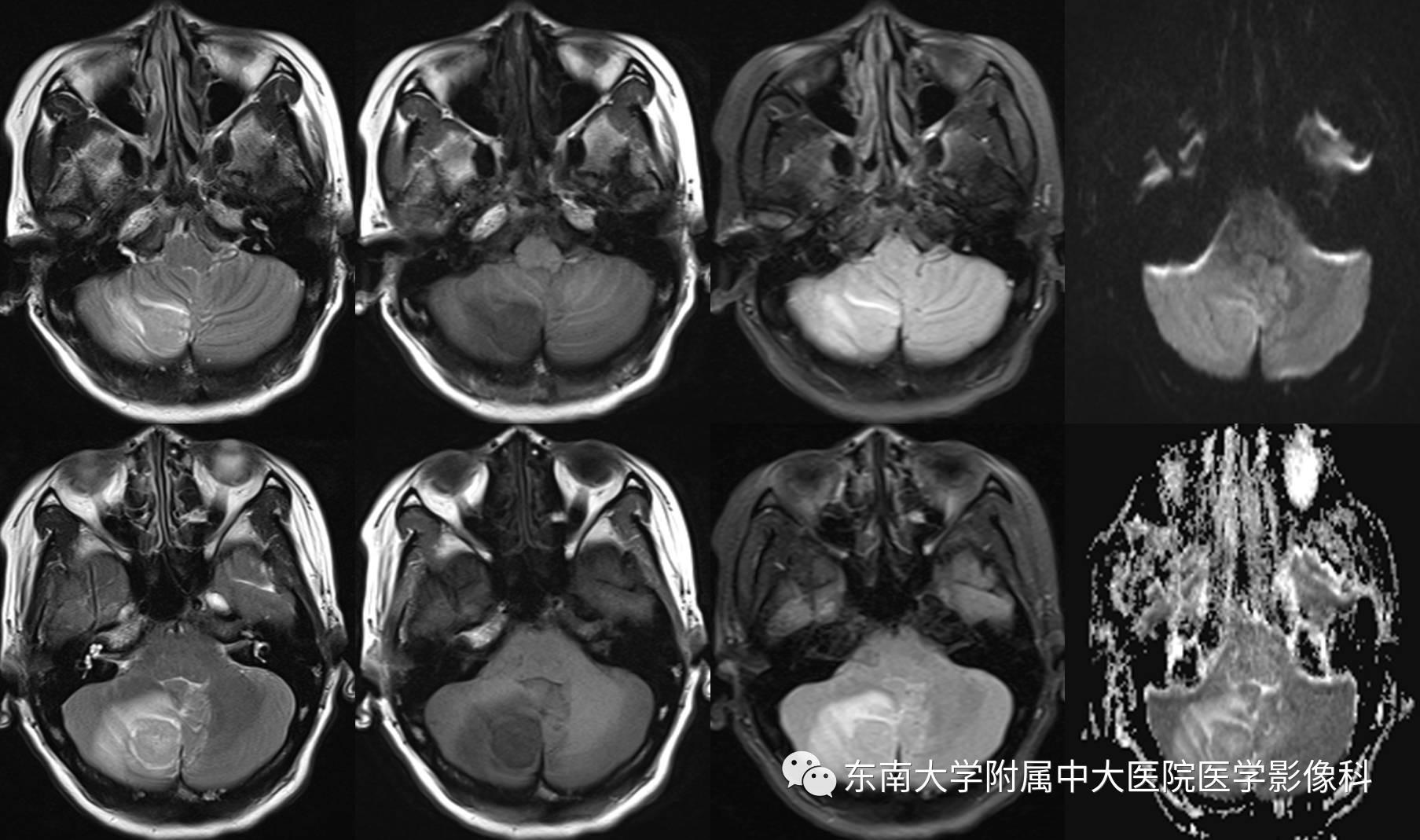 【病例】成人小脑肿瘤2例MR影像诊断