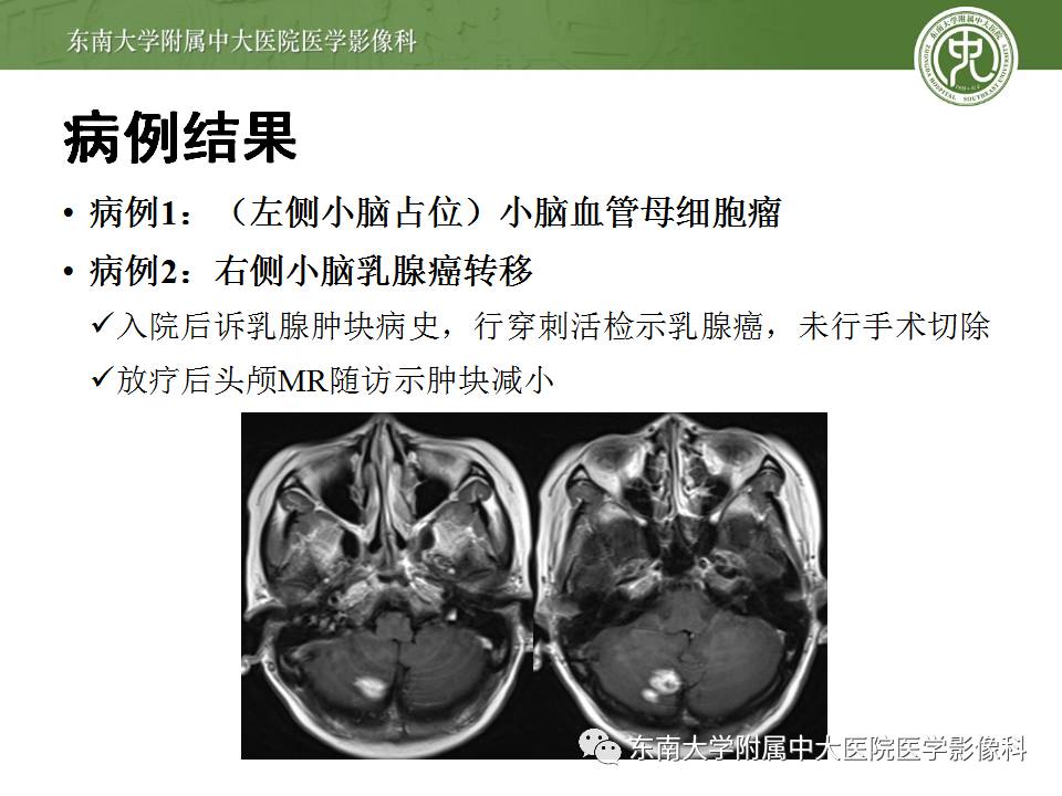 【病例】成人小脑肿瘤2例MR影像诊断