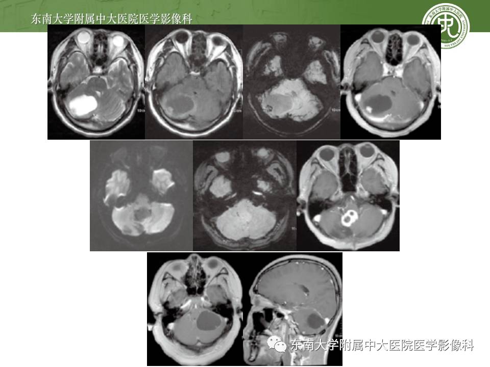 【病例】成人小脑肿瘤2例MR影像诊断
