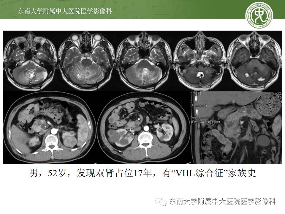 【病例】成人小脑肿瘤2例MR影像诊断