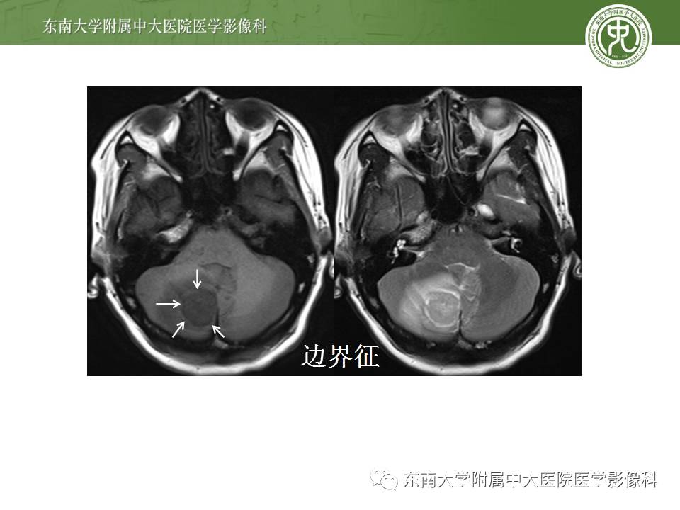 【病例】成人小脑肿瘤2例MR影像诊断