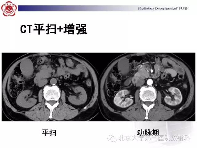 【病例】自身免疫性胰腺炎1例CT及MR影像诊断