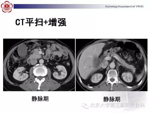 【病例】自身免疫性胰腺炎1例CT及MR影像诊断