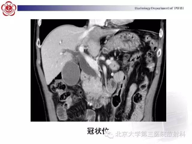 【病例】自身免疫性胰腺炎1例CT及MR影像诊断