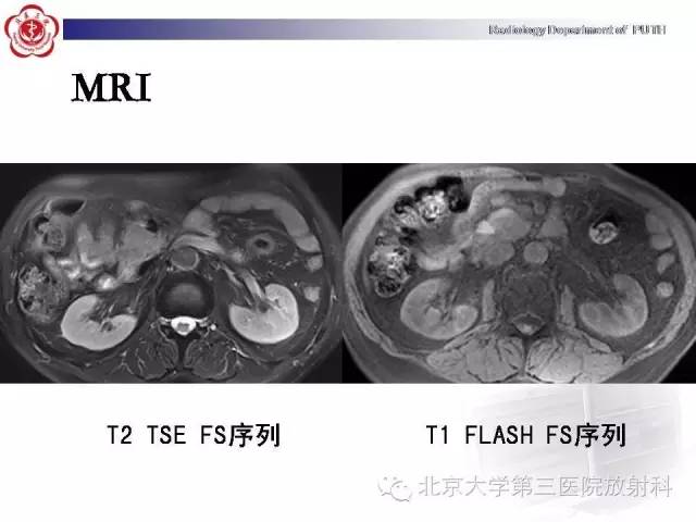 【病例】自身免疫性胰腺炎1例CT及MR影像诊断