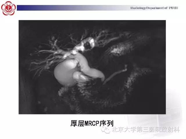 【病例】自身免疫性胰腺炎1例CT及MR影像诊断