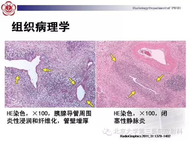 【病例】自身免疫性胰腺炎1例CT及MR影像诊断