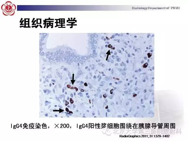 【病例】自身免疫性胰腺炎1例CT及MR影像诊断