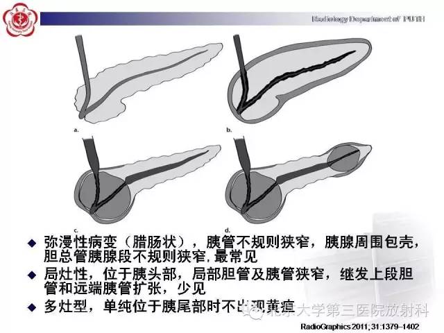 【病例】自身免疫性胰腺炎1例CT及MR影像诊断