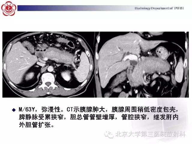 【病例】自身免疫性胰腺炎1例CT及MR影像诊断