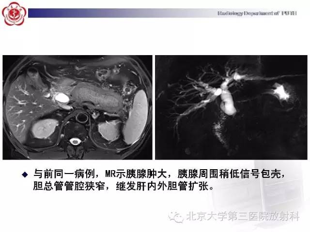 【病例】自身免疫性胰腺炎1例CT及MR影像诊断