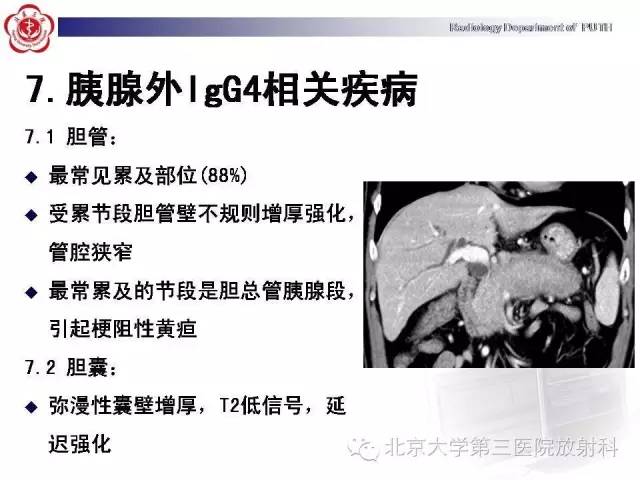 【病例】自身免疫性胰腺炎1例CT及MR影像诊断