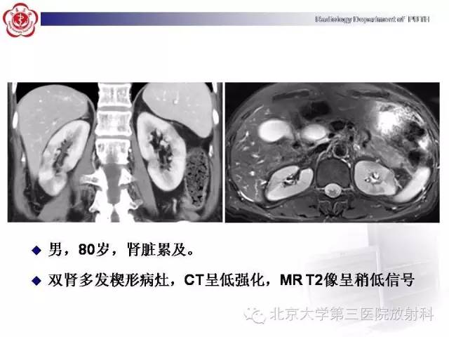 【病例】自身免疫性胰腺炎1例CT及MR影像诊断