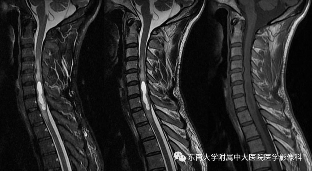 【病例】颈髓室管膜瘤1例MR影像表现