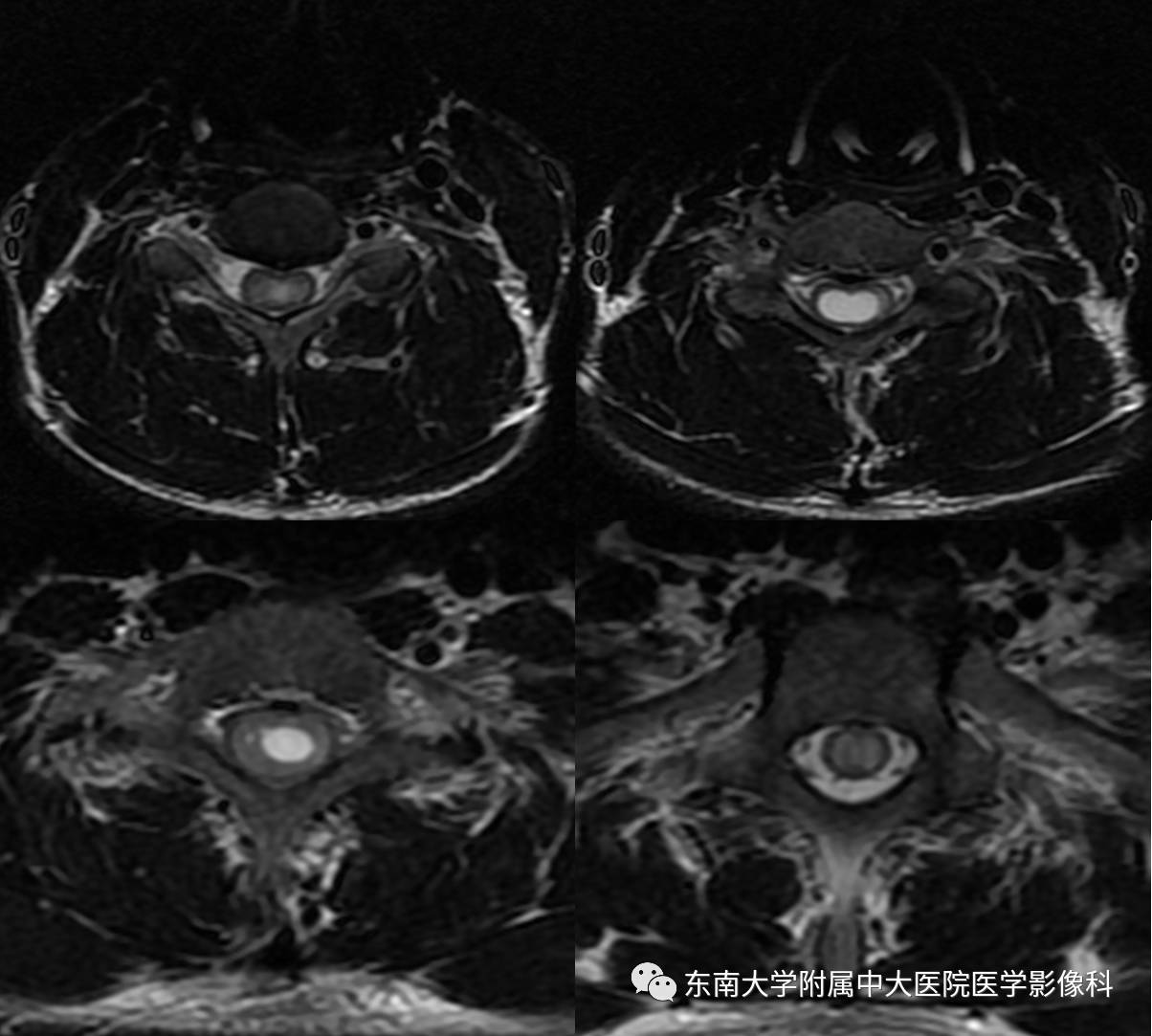 【病例】颈髓室管膜瘤1例MR影像表现