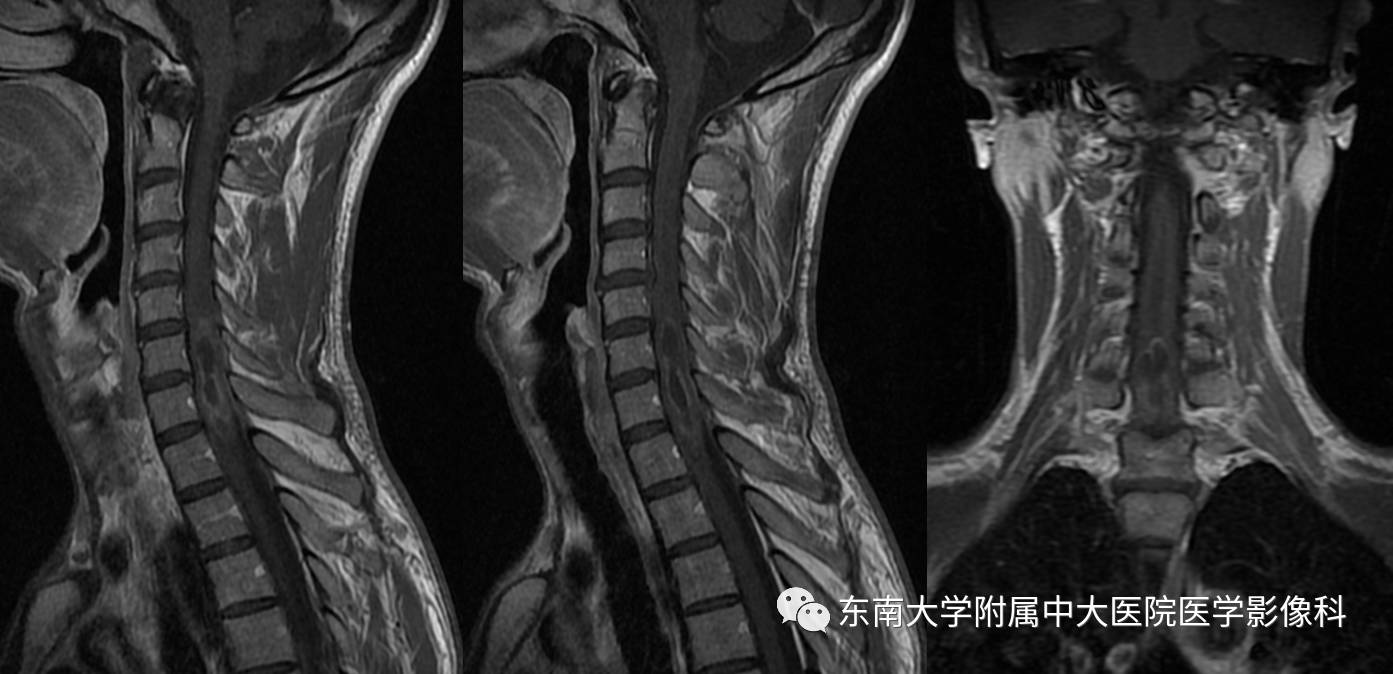 【病例】颈髓室管膜瘤1例MR影像表现