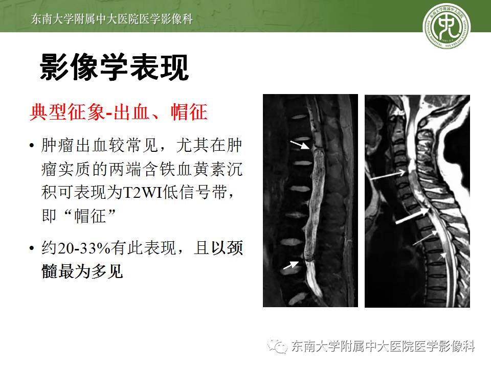 【病例】颈髓室管膜瘤1例MR影像表现