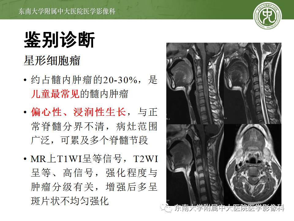 【病例】颈髓室管膜瘤1例MR影像表现