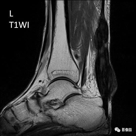 【病例】双侧跟腱多发结节性黄色瘤1例MR影像表现 【病例】双侧跟腱多发结节性黄色瘤1例MR影像表现