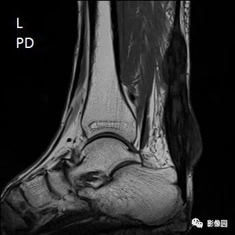 【病例】双侧跟腱多发结节性黄色瘤1例MR影像表现 【病例】双侧跟腱多发结节性黄色瘤1例MR影像表现